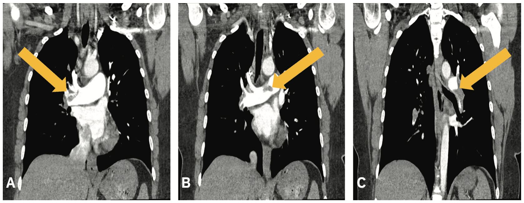 Management of Submassive Pulmonary Embolism With Aspiration Thrombectomy